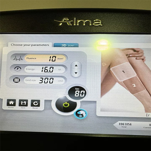 Alma Soprano Platinum Ice Laser Machine - Image 4